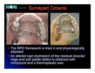 Crown Rpd Rest 12.(new)surveyed crowns and combined fixed rpd cases | PDF