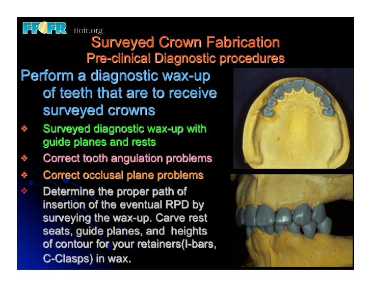 12.(new)surveyed crowns and combined fixed rpd cases
