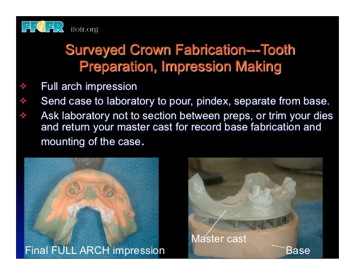 12.(new)surveyed crowns and combined fixed rpd cases