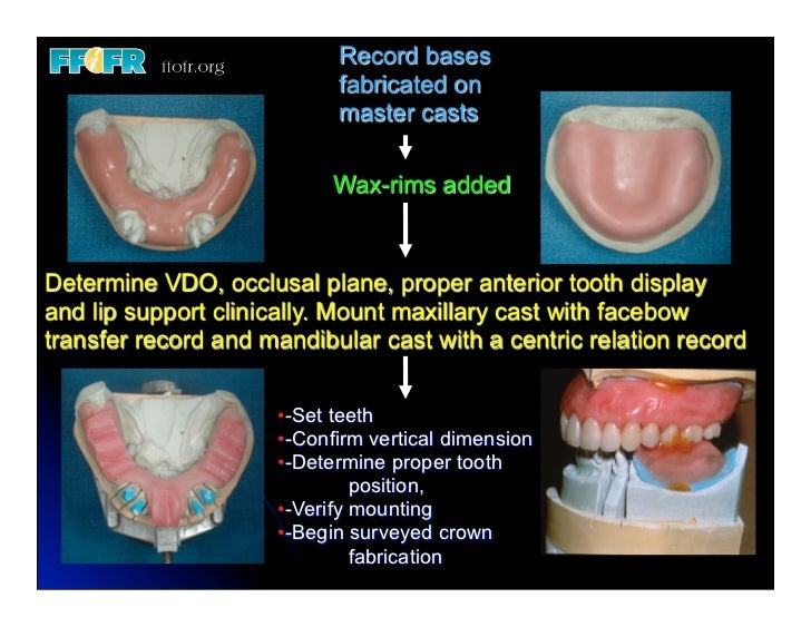 12.(new)surveyed crowns and combined fixed rpd cases