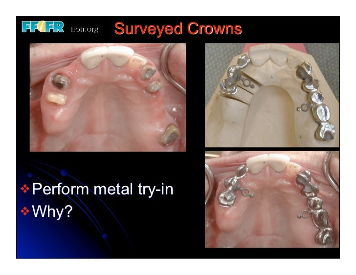 12.(new)surveyed crowns and combined fixed rpd cases