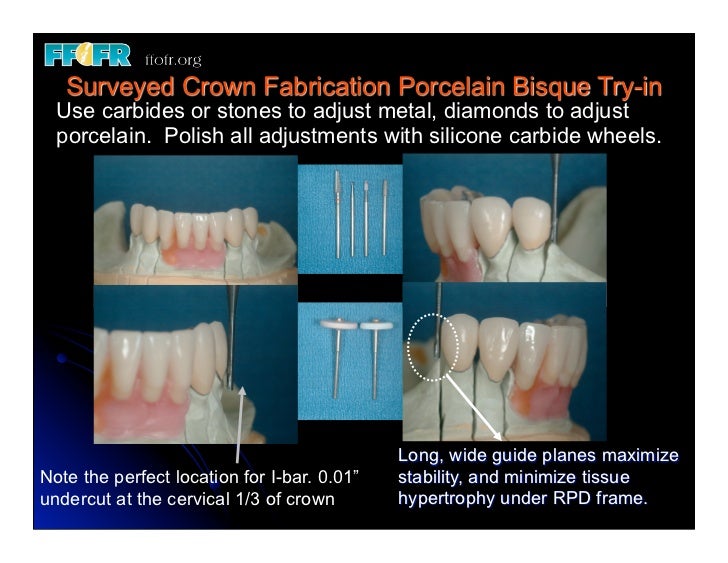 12.(new)surveyed crowns and combined fixed rpd cases