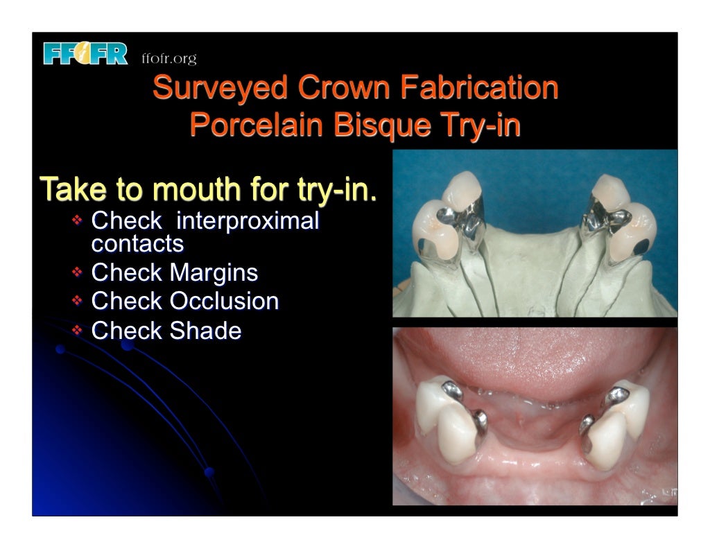 12.(new)surveyed crowns and combined fixed rpd cases