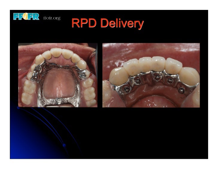 12.(new)surveyed crowns and combined fixed rpd cases
