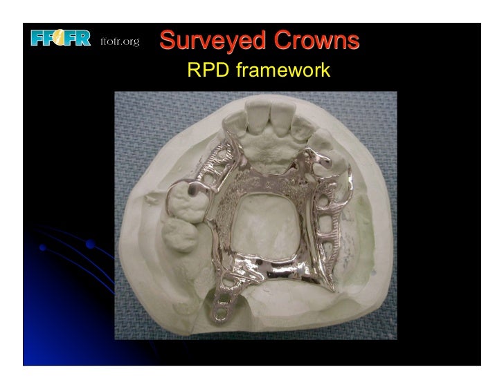 12.(new)surveyed crowns and combined fixed rpd cases