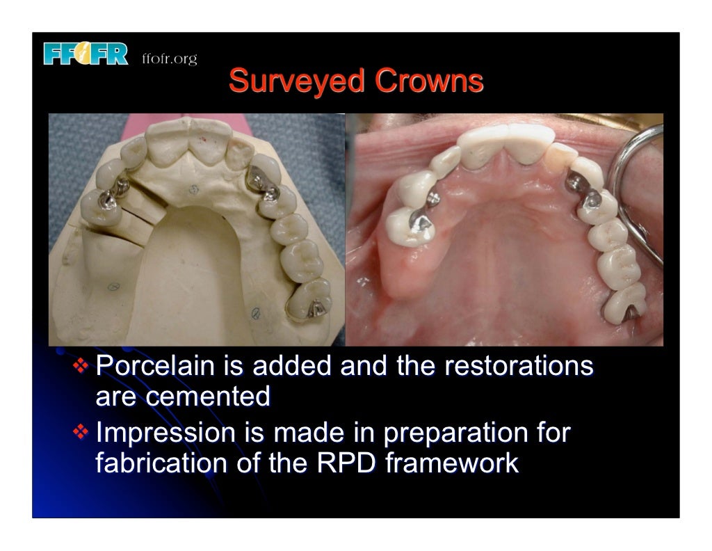 12.(new)surveyed crowns and combined fixed rpd cases