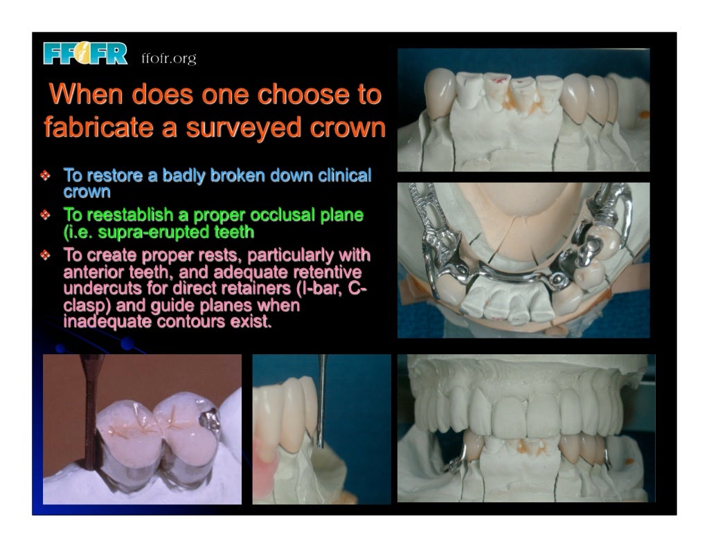 12.(new)surveyed crowns and combined fixed rpd cases
