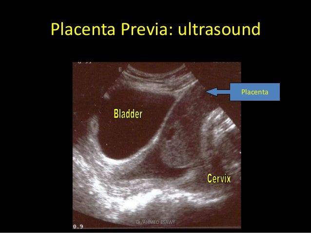 12-placenta imaging Dr Ahmed Esawy