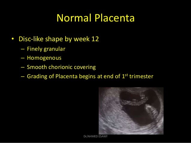12-placenta imaging Dr Ahmed Esawy