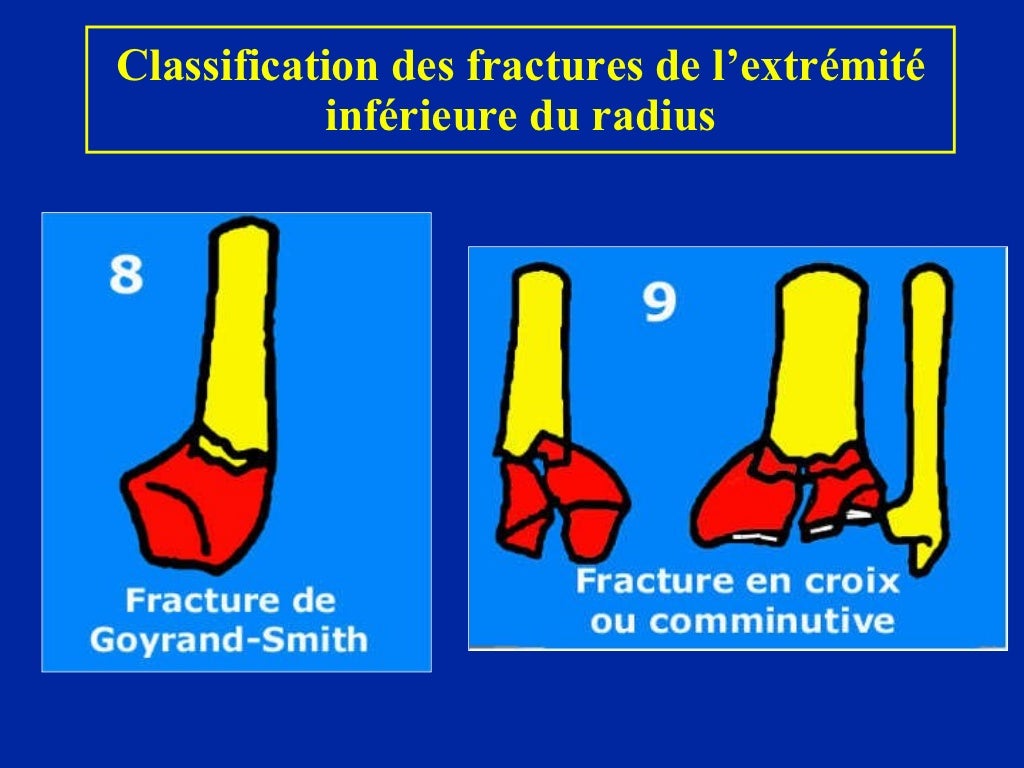12 Poignet Fractures 12-poignet-fractures