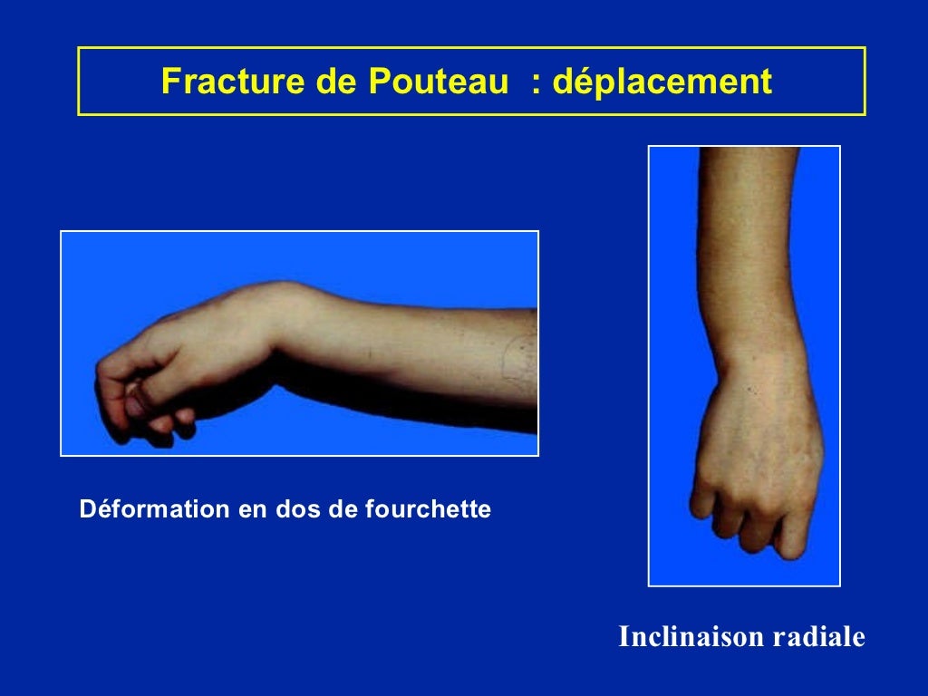 12 fractures