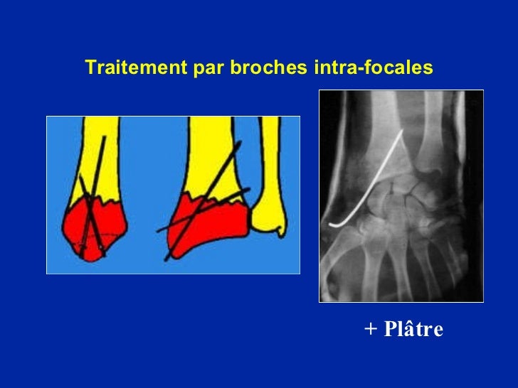 12 poignet - fractures