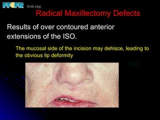 Radical Maxillectomy Defects
Results of over contoured anterior
extensions of the ISO.
  The mucosal side of the incision may dehisce, leading to
  the obvious lip deformity
 