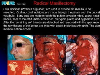 Radical Maxillectomy
Skin incisions (Weber-Fergusson) are used to expose the maxilla to be
resected. Oral mucosal incisions are made through the palate and the buccal
vestibule. Bony cuts are made through the palate, alveolar ridge, lateral nasal
bones, floor of the orbit, malar eminence, pterygoid plates and zygomatic arch.
After the remaining soft tissues are detached and removed with the specimen,
the raw tissues of the defect are lined with a split thickness skin graft. The skin
incision is then closed.
 