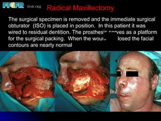 Radical Maxillectomy
The surgical specimen is removed and the immediate surgical
obturator (ISO) is placed in position. In this patient it was
wired to residual dentition. The prosthesis serves as a platform
for the surgical packing. When the wound is closed the facial
contours are nearly normal
 
