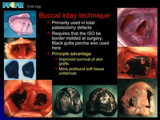 Buccal inlay technique
     Primarily used in total
      palatectomy defects
     Requires that the ISO be
      border molded at surgery.
      Black gutta percha was used
      here
     Principle advantage
          Improved survival of skin
           grafts
          More profound soft tissue
           undercuts
 