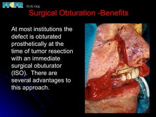Surgical Obturation -Benefits

At most institutions the
defect is obturated
prosthetically at the
time of tumor resection
with an immediate
surgical obuturator
(ISO). There are
several advantages to
this approach.
 
