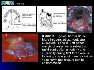 a

aa           b                     c




     d
                 a and b. Typical border defect.
                 More frequent adjustments are
                 expected. c and d: Soft palate
                 margin of resection is subject to
                 rapid contraction anteriorly and
                 superiorly during first three weeks
                 following surgery. On rare occasions
                 velopharyngeal closure can be
                 compromised.
 