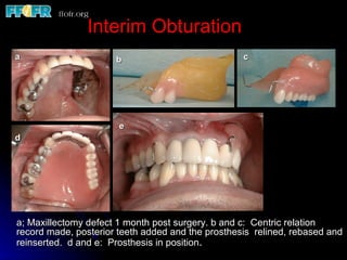 Interim Obturation
a                     b                            c




                       e
d




a; Maxillectomy defect 1 month post surgery. b and c: Centric relation
record made, posterior teeth added and the prosthesis relined, rebased and
reinserted. d and e: Prosthesis in position.
 