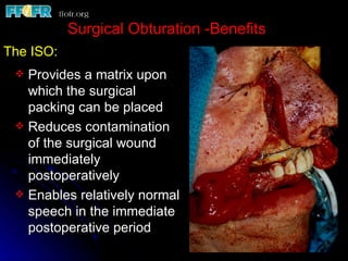 Surgical Obturation -Benefits
The ISO:
  Provides a matrix upon
   which the surgical
   packing can be placed
  Reduces contamination
   of the surgical wound
   immediately
   postoperatively
  Enables relatively normal
   speech in the immediate
   postoperative period
 