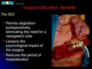 Surgical Obturation -Benefits
The ISO:

 Permits deglutition
  postoperatively,
  eliminating the need for a
  nasogastric tube
 Lessens the
  psychological impact of
  the surgery
 Reduces the period of
  hospitalization
 