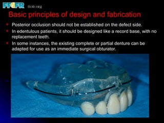 Basic principles of design and fabrication
   Posterior occlusion should not be established on the defect side.
   In edentulous patients, it should be designed like a record base, with no
    replacement teeth.
   In some instances, the existing complete or partial denture can be
    adapted for use as an immediate surgical obturator.
 