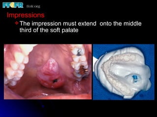 Impressions
   The impression must extend onto the middle
   third of the soft palate
 