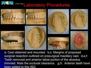 Laboratory Procedures
a                      b             c                d




                   f

e                                                     h


                                     g




    a: Cast obtained and mounted. b,c: Margins of proposed
    surgical resection outlined on presurgical maxillary cast. d,e,f:
    Teeth removed and anterior labial portion of the alveolus
    trimmed. Note the occlusal clearance. g,h: Anterior teeth have
    been added to this ISO.
 
