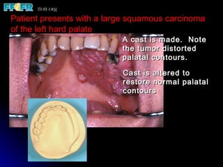 Patient presents with a large squamous carcinoma
of the left hard palate
                           A cast is made. Note
                           the tumor distorted
                           palatal contours.

                           Cast is altered to
                           restore normal palatal
                           contours
 