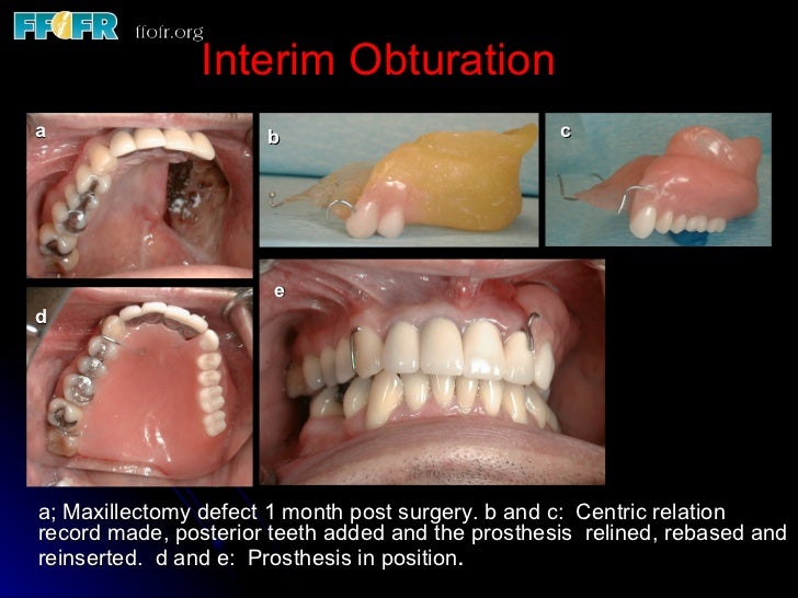 Surgical and Interim Obturation