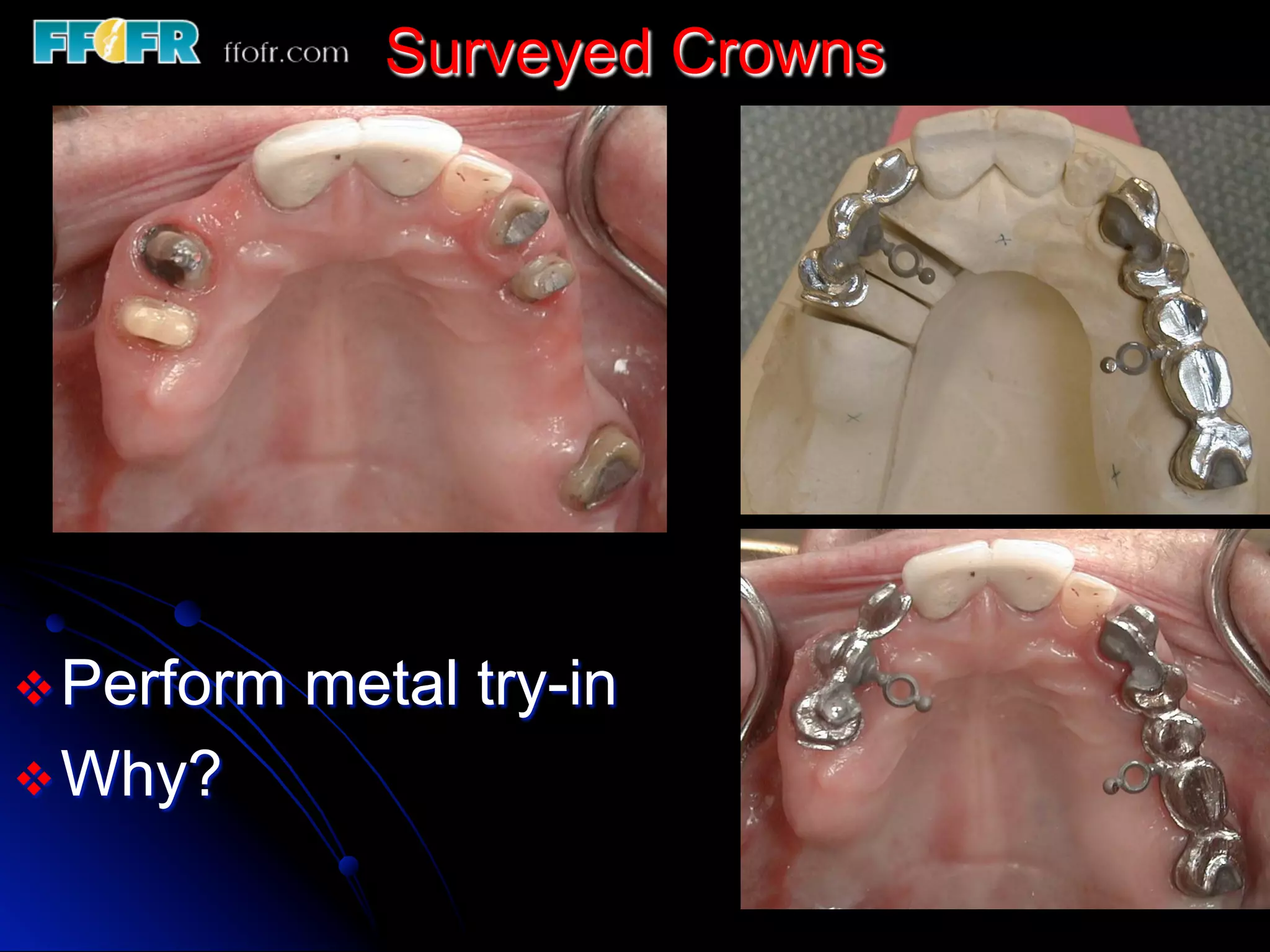 Surveying Rpd 12.surveyed crowns and combined fixed rpd cases | PDF