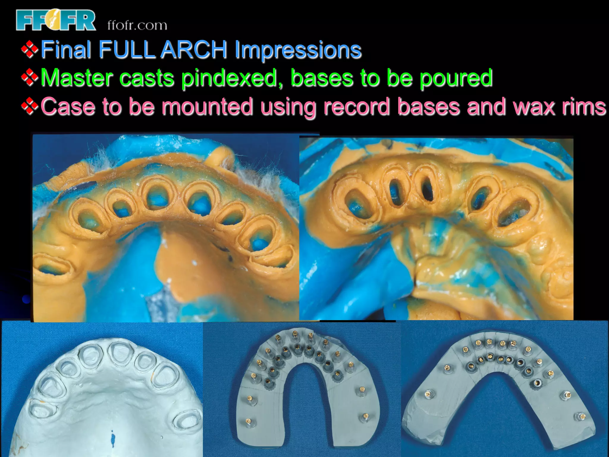 12.surveyed crowns and combined fixed rpd cases | PDF