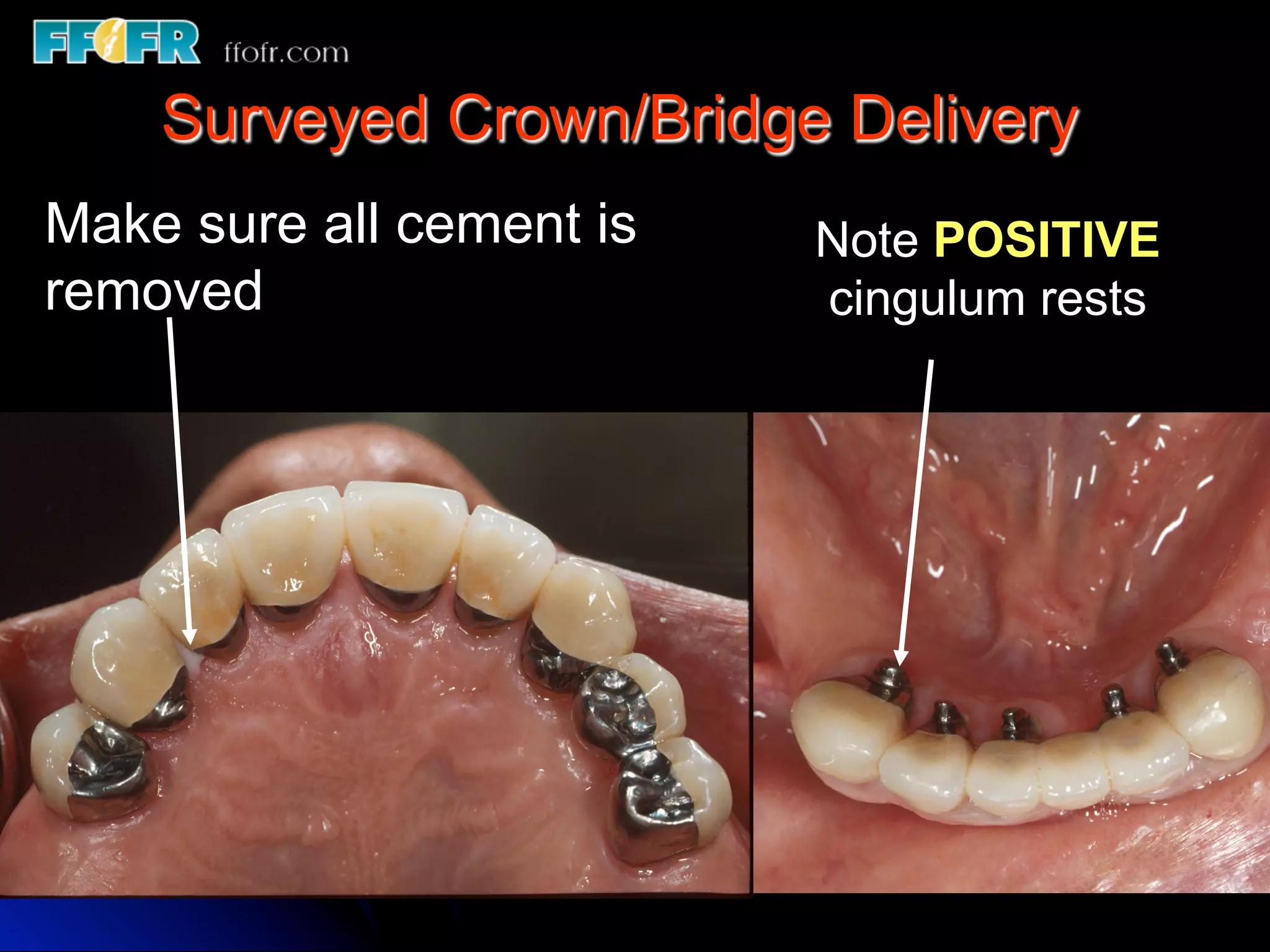 12.surveyed crowns and combined fixed rpd cases | PDF
