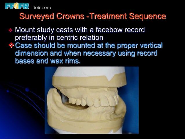 Crown Rpd 12.surveyed crowns and combined fixed rpd cases | PDF