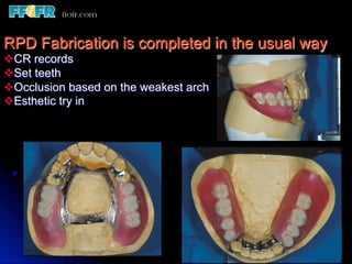 Occlusal Record Rpd 12.surveyed crowns and combined fixed rpd cases | PDF