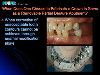 Crown Rpd 12.surveyed crowns and combined fixed rpd cases | PDF
