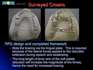 12.surveyed crowns and combined fixed rpd cases | PDF