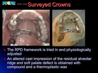 12.surveyed crowns and combined fixed rpd cases | PDF