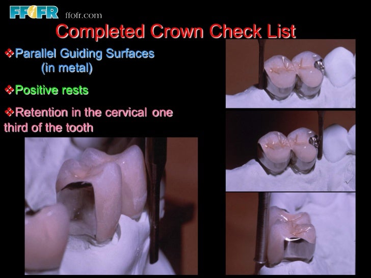 12.surveyed crowns and combined fixed rpd cases