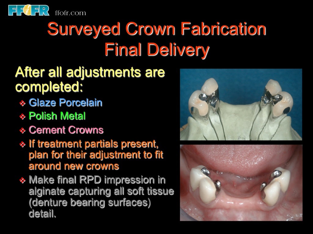 12.surveyed crowns and combined fixed rpd cases