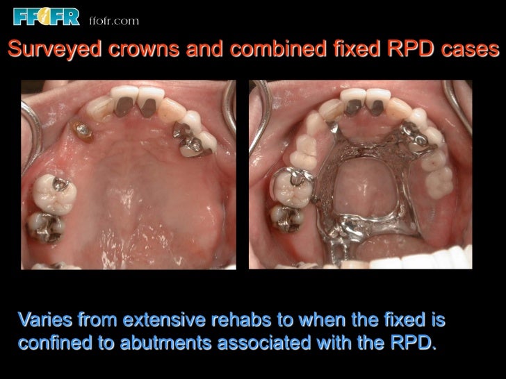 12.surveyed crowns and combined fixed rpd cases
