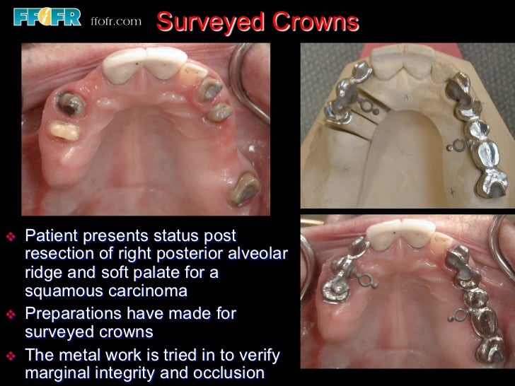 12.surveyed crowns and combined fixed rpd cases