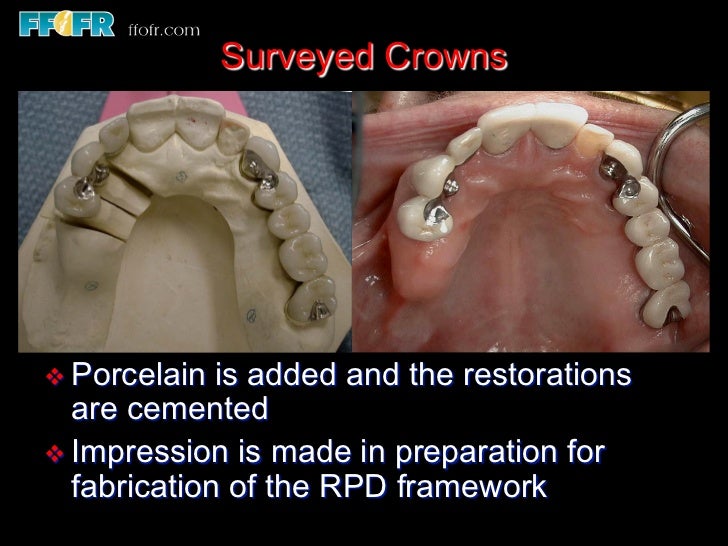 12.surveyed crowns and combined fixed rpd cases