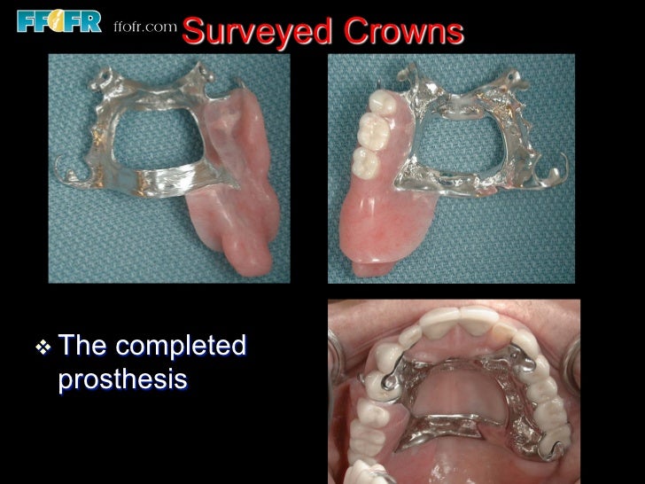 12.surveyed crowns and combined fixed rpd cases
