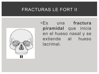FRACTURAS LE FORT II


      Es     una    fractura
       piramidal que inicia
       en el hueso nasal y se
       extiende   al    hueso
       lacrimal.
 