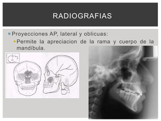 RADIOGRAFIAS

 Proyecciones AP, lateral y oblicuas:
   Permite la apreciacion de la rama y cuerpo de la
    mandíbula.
 