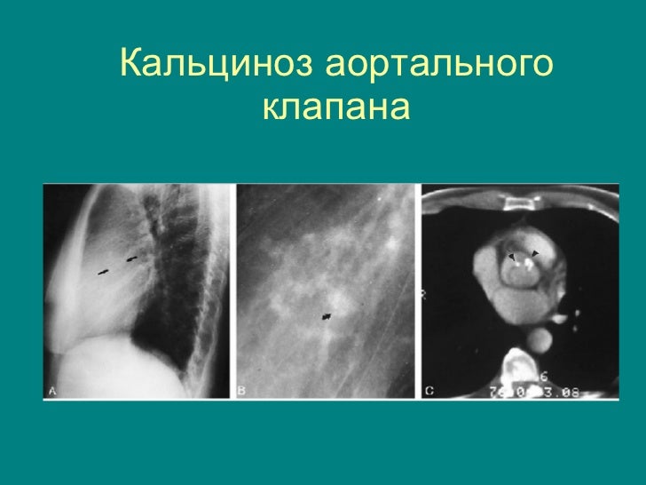 Кальциноз сердечного клапана
