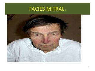 FACIES MITRAL.




                 16
 