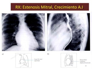 RX: Estenosis Mitral, Crecimiento A.I.




                                         19
 
