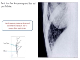 Las líneas septales se deben al
   edema intersticial, por la
     congestión pulmonar.




                                  20
 